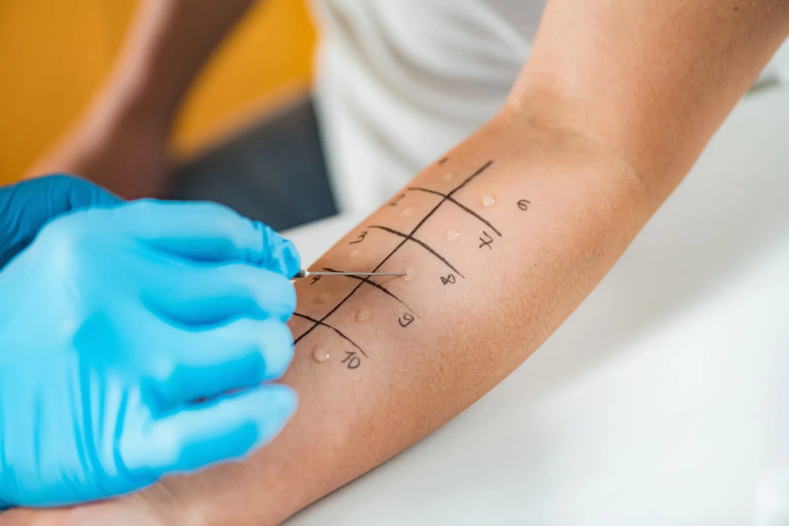 Skin prick allergy testing